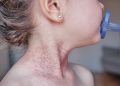 Early Respiratory Infections Linked to Childhood AD Risk