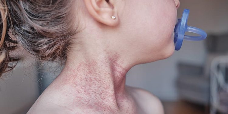 Early Respiratory Infections Linked to Childhood AD Risk