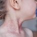 Early Respiratory Infections Linked to Childhood AD Risk