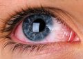 Chronic Pain Conditions Linked to Risk for Dry Eye Disease