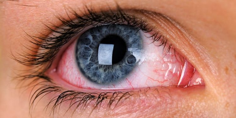 Chronic Pain Conditions Linked to Risk for Dry Eye Disease