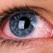 Chronic Pain Conditions Linked to Risk for Dry Eye Disease