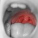 Oral Steroids After Tonsillectomy May Modestly Cut Kids’ Pain