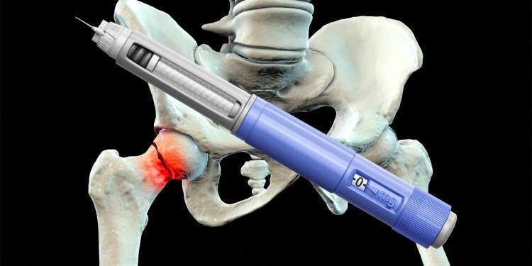 Study Links GLP-1s to Lower Risk of Fragility Fractures in Diabetes Patients