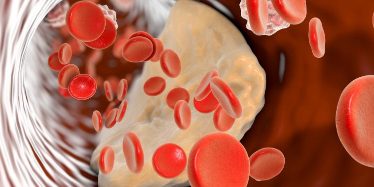 Cardiologists Say Adding This Quick Test Gives a  Clearer Picture on Cholesterol Levels