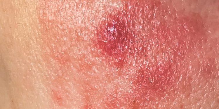 Women Show Better Survival in Rare Skin Cancer
