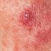 Women Show Better Survival in Rare Skin Cancer