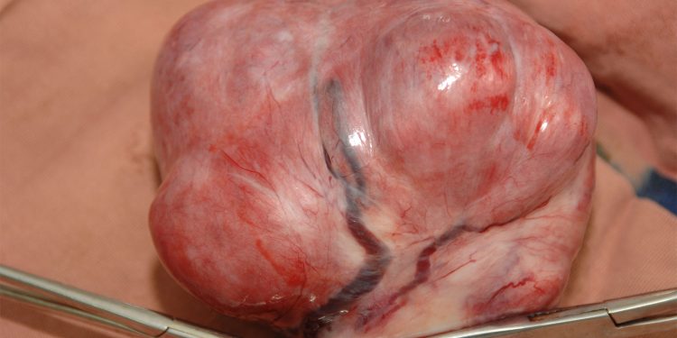 Two Procedures May Yield Similar Symptom Relief for Uterine Fibroids