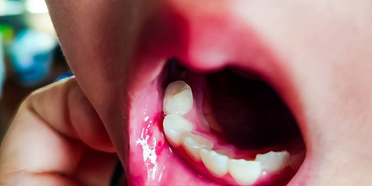 Genital Aphthosis Linked to Systemic Diagnoses in Children