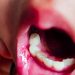 Genital Aphthosis Linked to Systemic Diagnoses in Children