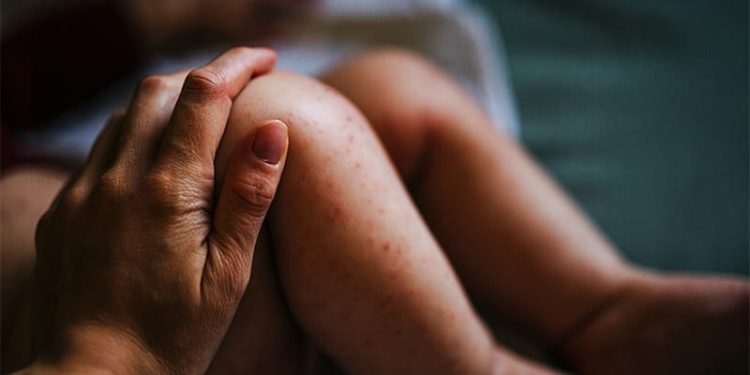 Infant Eczema Location Tied to Risk for Food Allergy