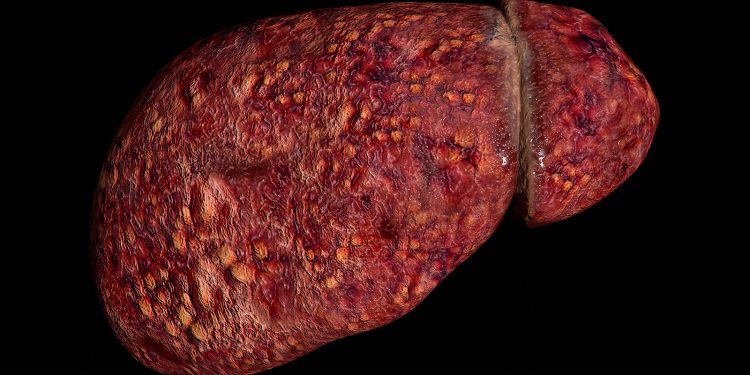 Study Assesses Who’s at Risk for Young-Onset MASLD Cirrhosis