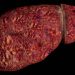 Study Assesses Who’s at Risk for Young-Onset MASLD Cirrhosis