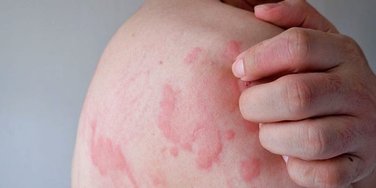 Omalizumab May Ease Inflammation in Chronic Urticaria