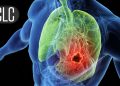 Drug Combo’s Response Rates Top 90% in Small Cell Lung Cancer Trial