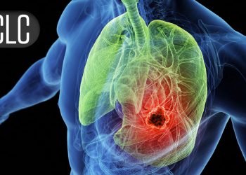 Drug Combo’s Response Rates Top 90% in Small Cell Lung Cancer Trial