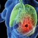 Drug Combo’s Response Rates Top 90% in Small Cell Lung Cancer Trial