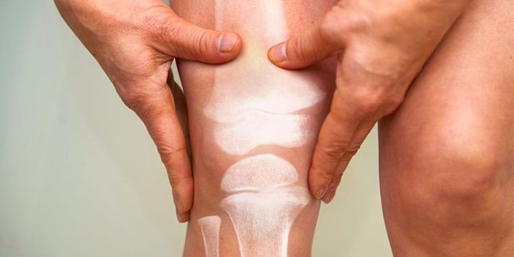Colchicine Shows No Benefit Over Placebo in Knee OA Pain