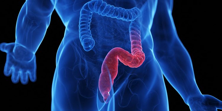 GLP-1s May Offer Benefit in Ulcerative Colitis, Real-World Data Suggest
