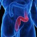 GLP-1s May Offer Benefit in Ulcerative Colitis, Real-World Data Suggest