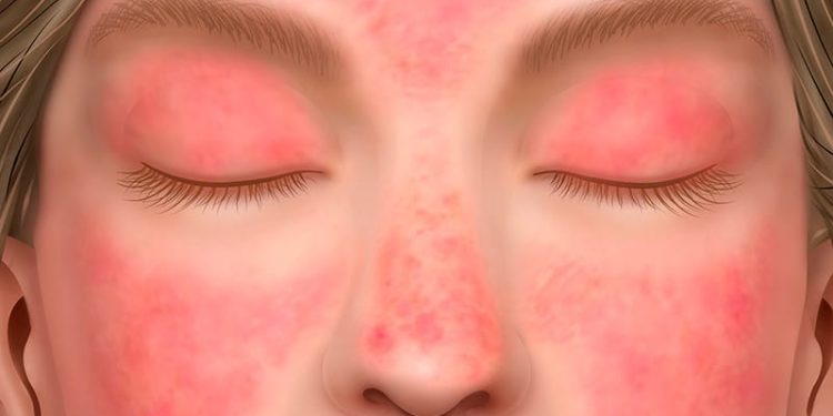 Brepocitinib Controls Skin Disease in Dermatomyositis