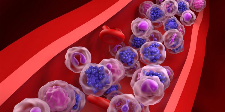 A Deep Dive Into Double-Hit Lymphoma