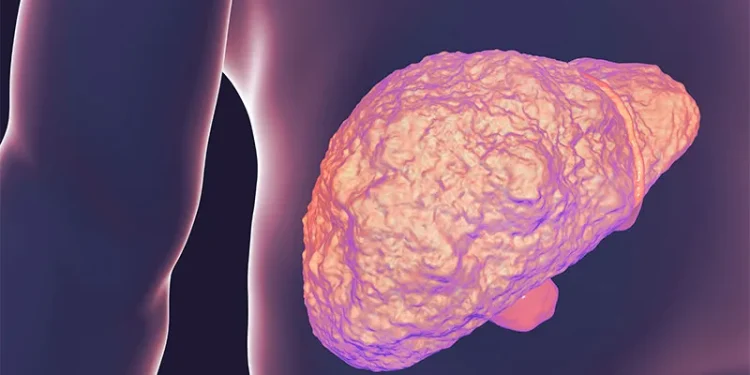 MASH: Efruxifermin Linked to Sustained Fibrosis Response